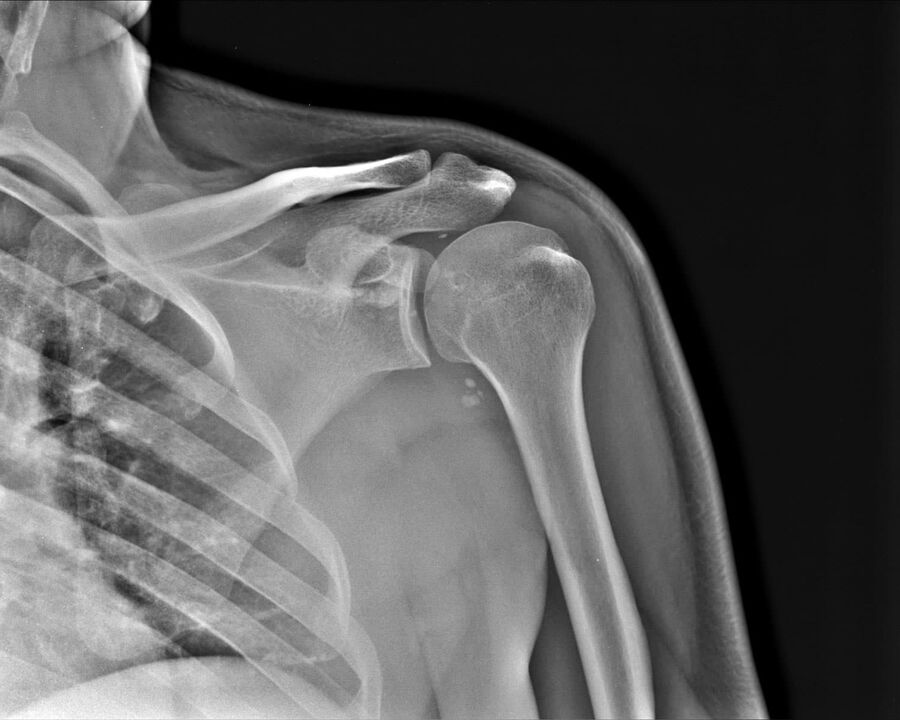 Röntgenfoto van artrose van het schoudergewricht van de 2e graad van ernst