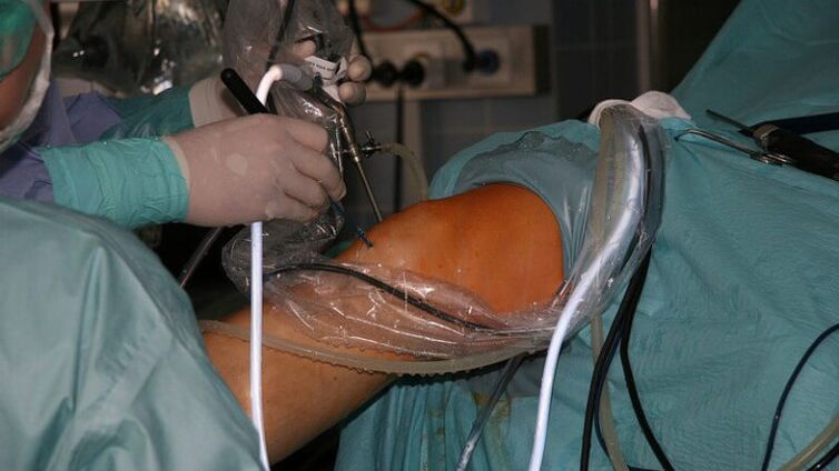 chirurgische behandeling van artrose