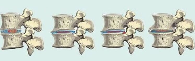 spinale laesie in geval van thoracale osteochondrose