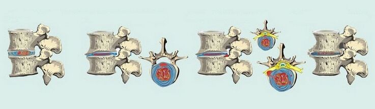 Stadia van de vorming van osteochondrose van de wervelkolom