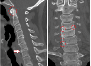 De CT-scan toont beschadigde wervels en schijven van heterogene hoogte als gevolg van thoracale osteochondrose