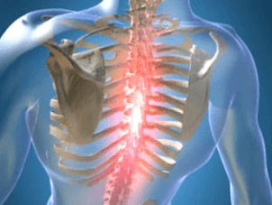 Terugkerende of aanhoudende pijn bij osteochondrose op de borst