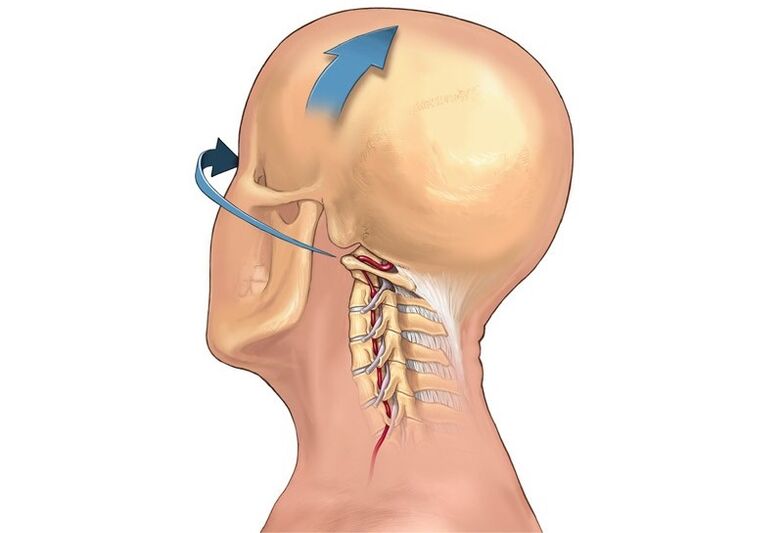 nekcrunch bij het draaien van het hoofd als een symptoom van cervicale osteochondrose