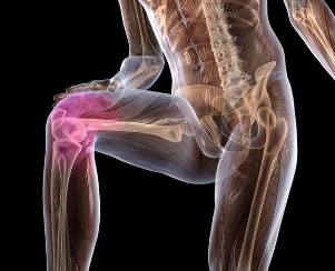 Ontsteking van het kniegewricht met artrose