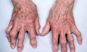 hoe artritis van vingers te onderscheiden van artrose