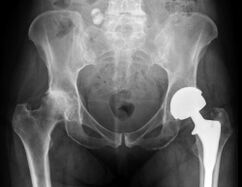 diagnose van artrose van het heupgewricht