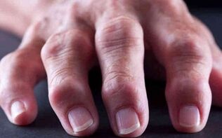 reumatoïde artritis als oorzaak van gewrichtspijn